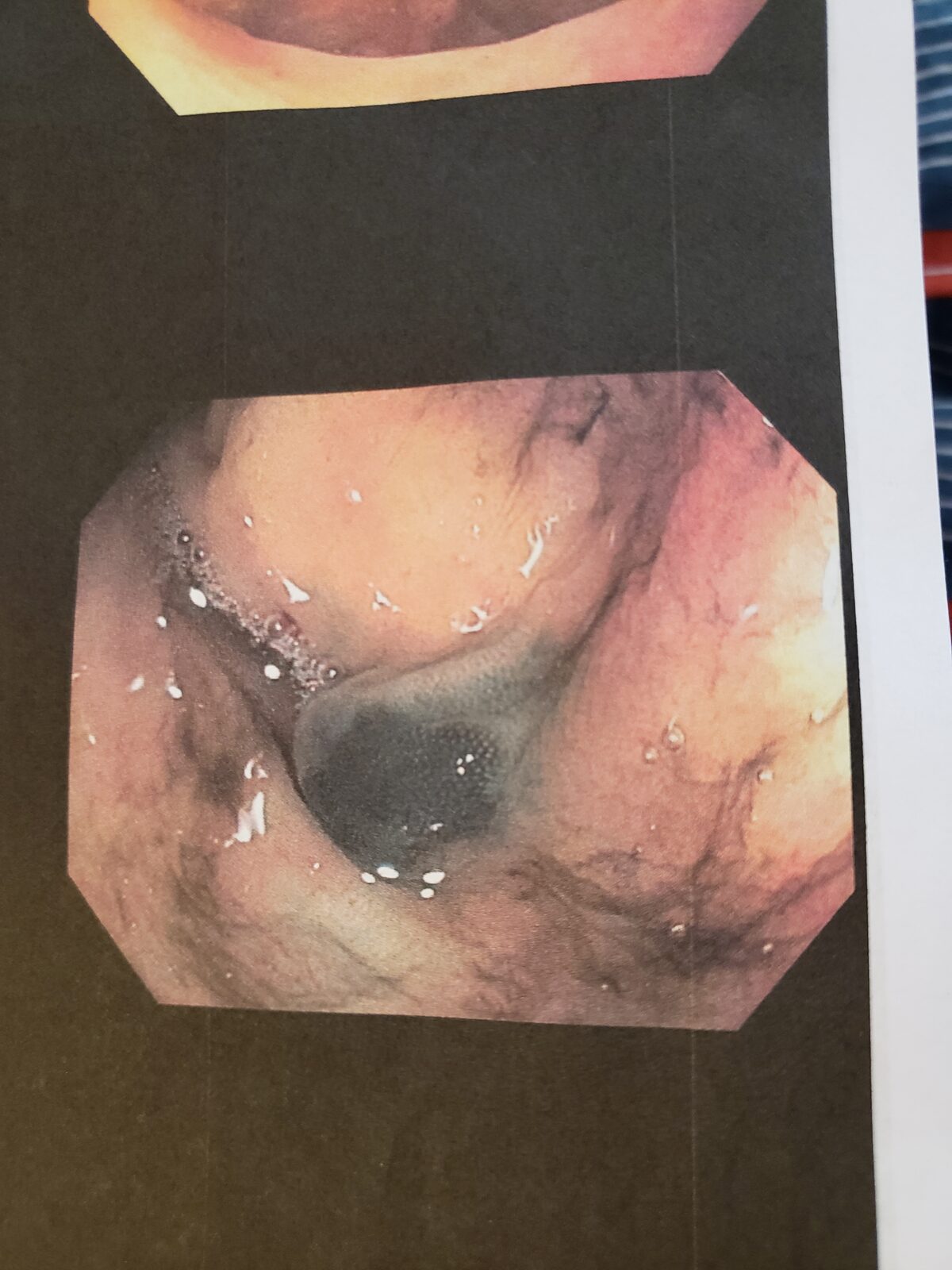 Photo of my colon tumor