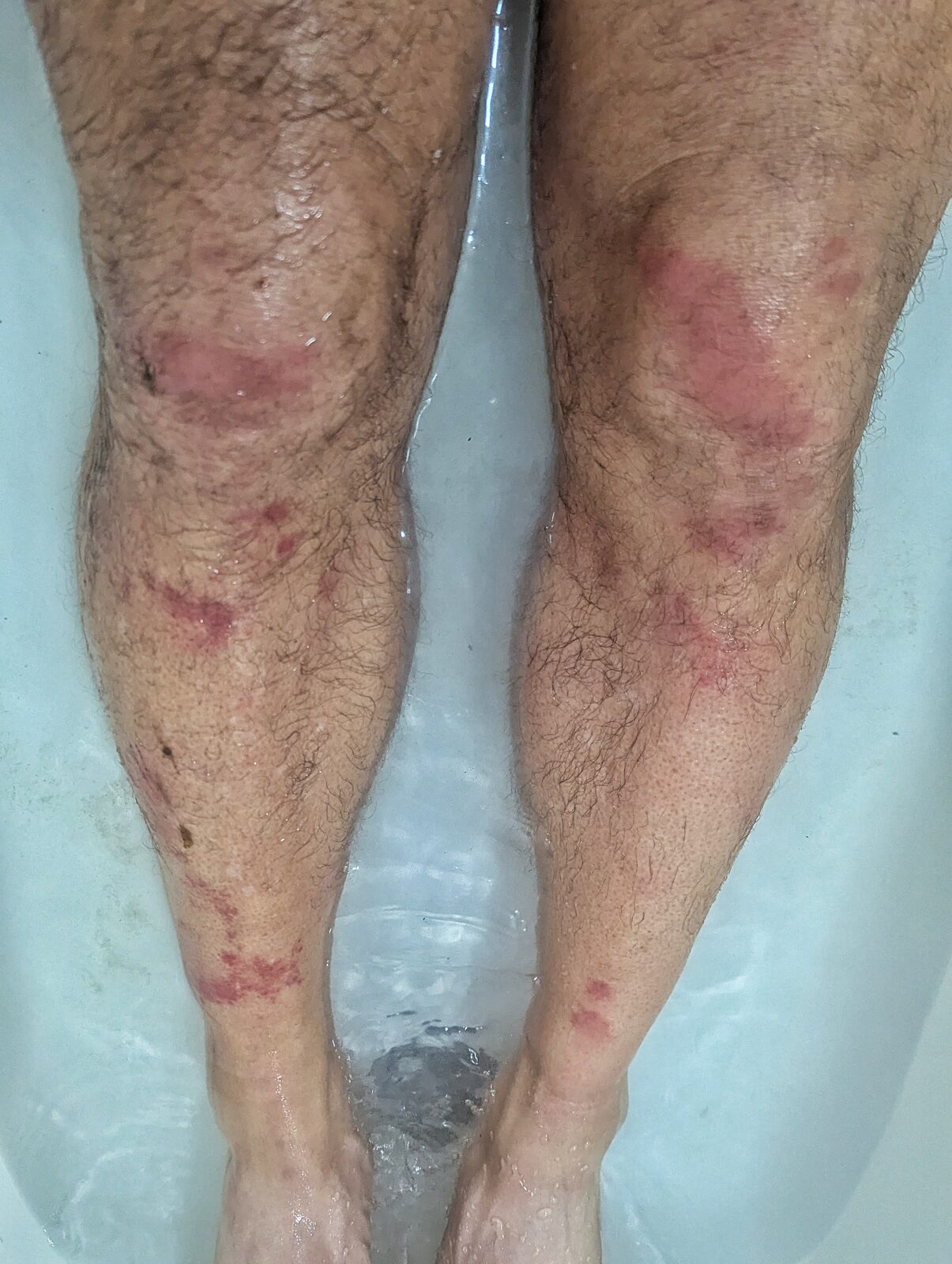 Bruised legs in bathtub