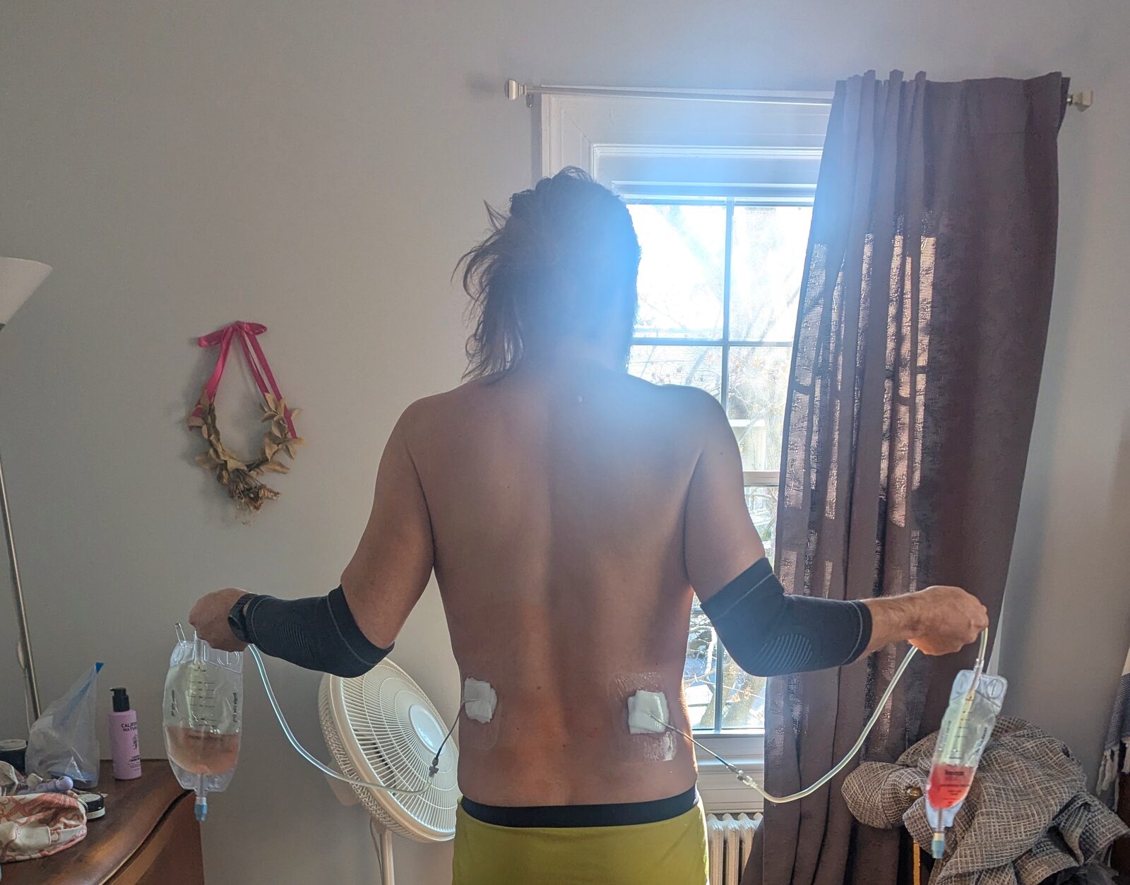 Nephrostomy tubes coming out of my back